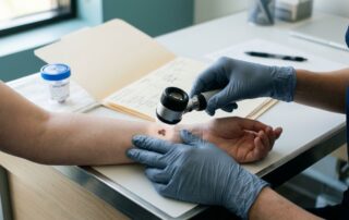 A gloved hand examines a dark mole beside a medical file and biopsy container.