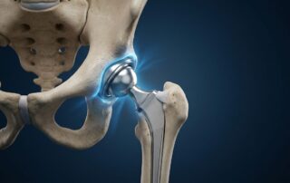 3D illustration of a titanium hip implant in a human joint on a blue background.